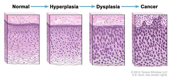 Hyperplasia-dysplasia-cancer-progression-article.jpg