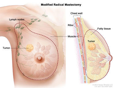 ModRadicalMastectomy4.jpg