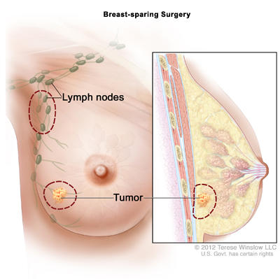 BreastSparingSurgRtHalfOnly2.jpg