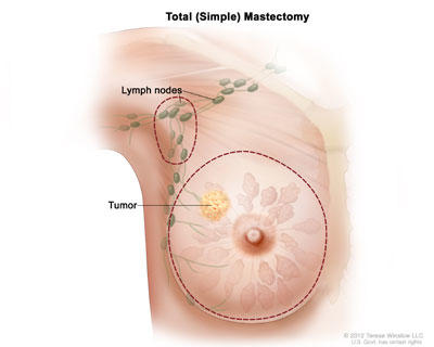 TotalSimpleMastectomy4.jpg