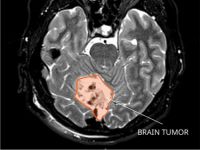 Medulloblastoma (Article).jpg