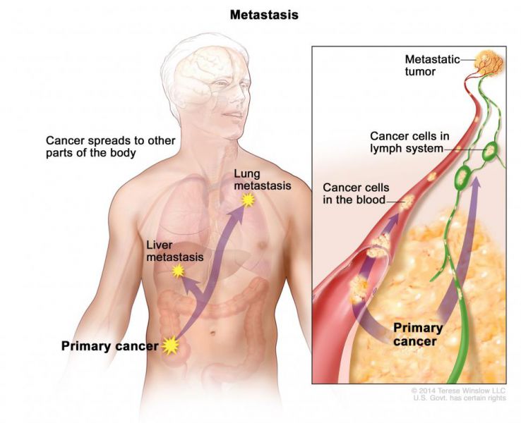 File:Metastasis-enlarge.jpg